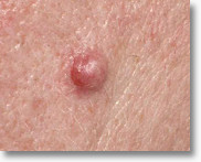 Congenital and Interadermal Nevus