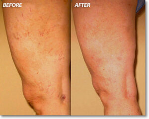 varicose veins