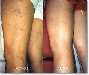 varicose veins