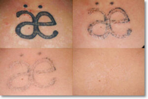 tattoo removal