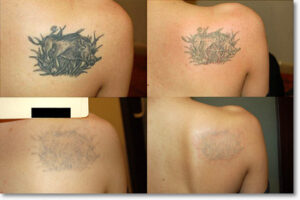 tattoo removal