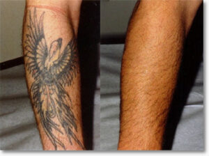 tattoo removal